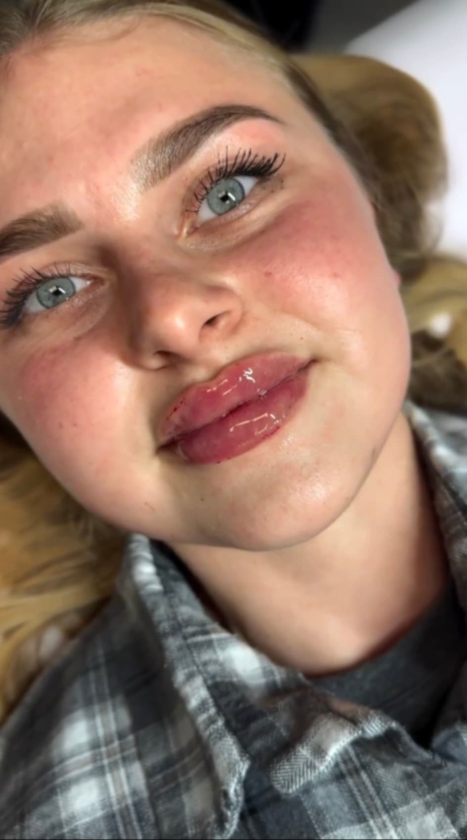 Licensed nurse administering lip filler at AP Beauty Studio wellness suite Vaughan