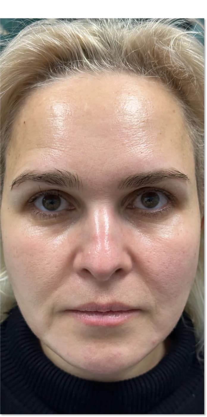 After: the same client, front view