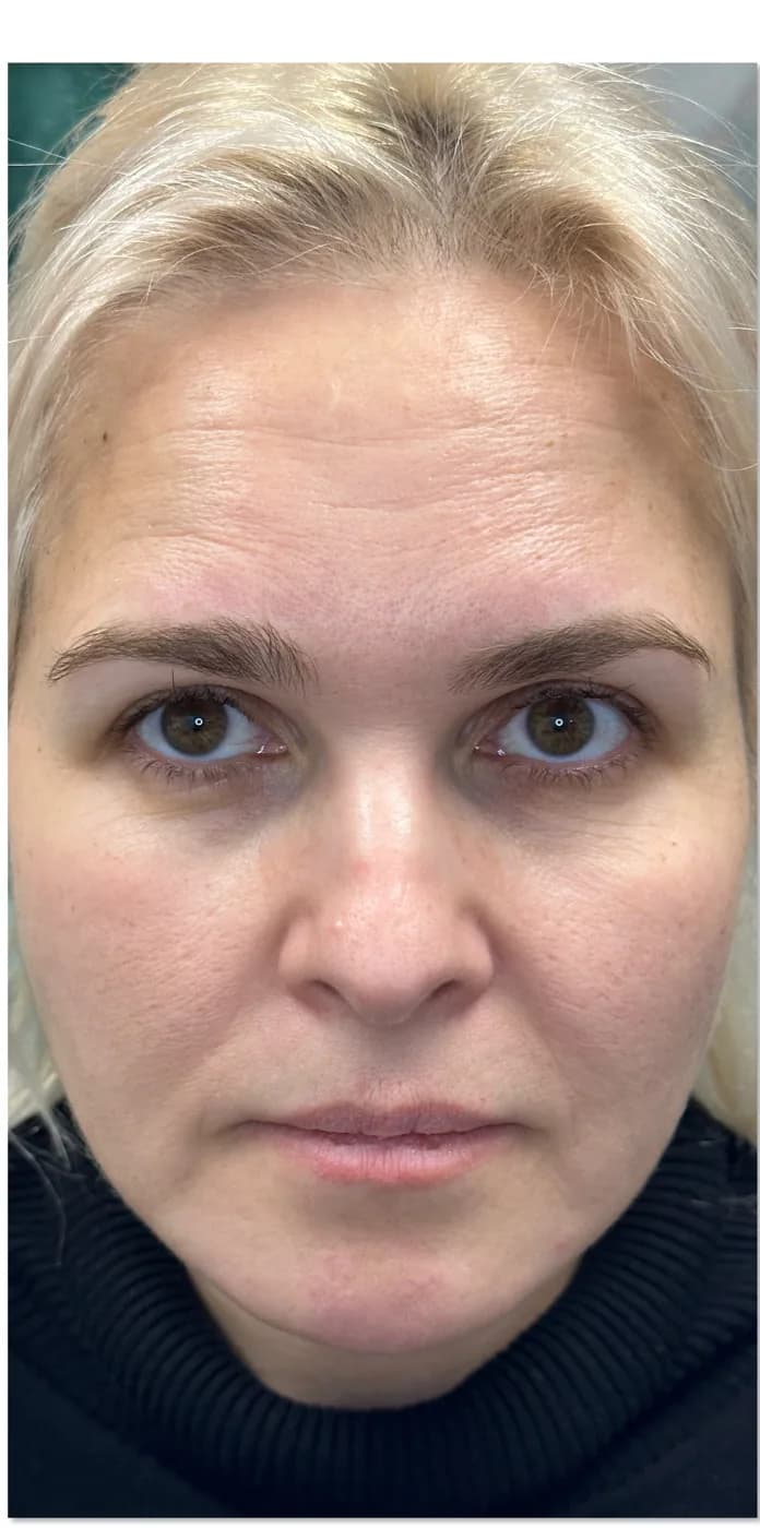 Before: client face, front view