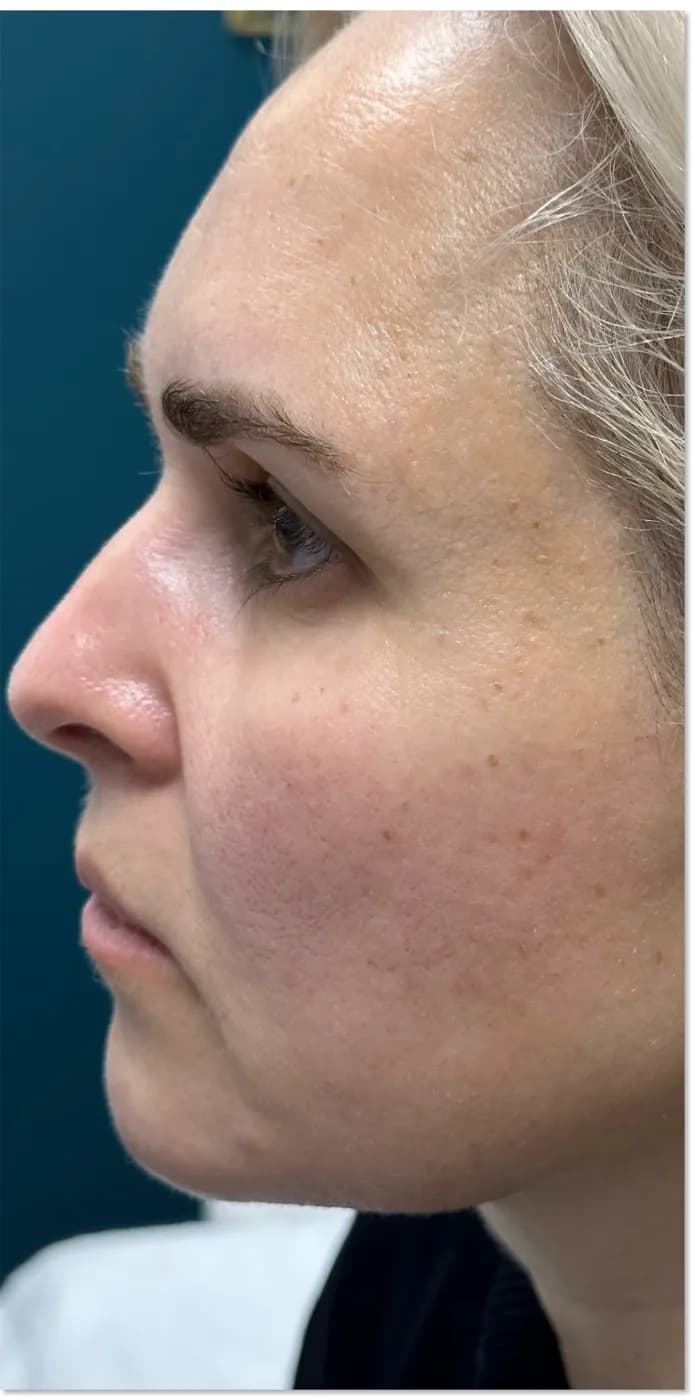 After: the same client, side view