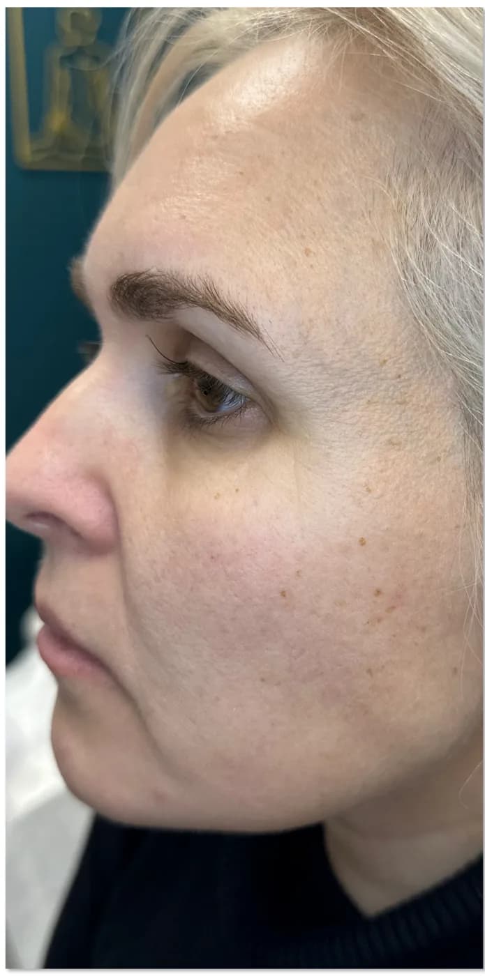 Before: client face, side view